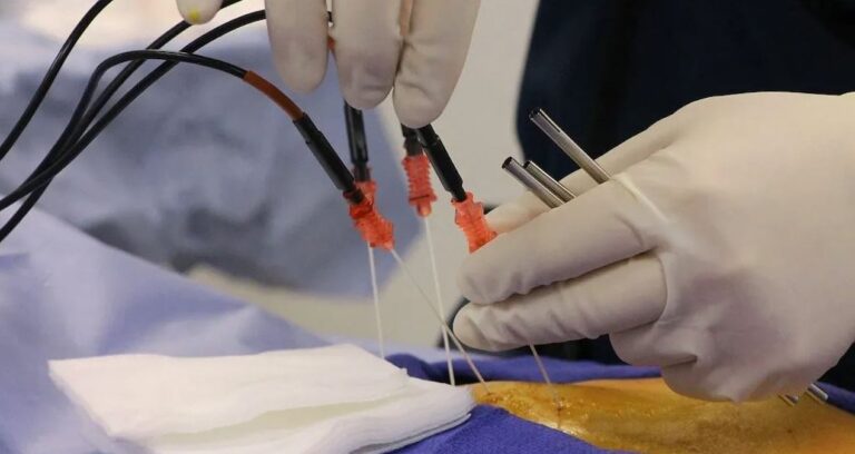 13 yillik bel fitigindan tek bir islemle kurtuldu bir haftada normal hayatina dondu FOjsbD6j